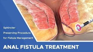 Closure of Fistula Tract with Laser [upl. by Schlesinger]