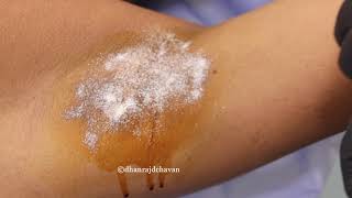 Excess Sweating of Underarms Treatment  Hyperhidrosis Botox Treatment  Dr Dhanraj Chavan Pune [upl. by Fugere]