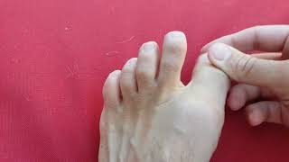 Big toe joint pain and problems explained [upl. by Rimisac]