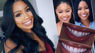 MY 30000 SMILE TRANSFORMATION  VENEERS EXPERIENCE [upl. by Ardeen]