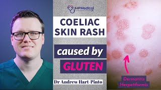 Dermatitis Herpetiformis Skin Rash Linked To Coeliac Disease Celiac And Gluten Intolerance [upl. by Eissirhc575]