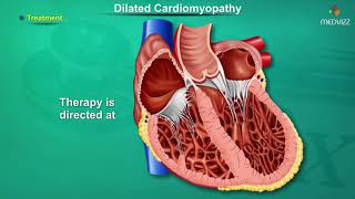 Dilated cardiomyopathy  DCM   Causes Signs and Symptoms Pathogenesis Diagnosis and Treatment [upl. by Korff]