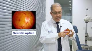 Neuritis optica  Neuro Oftalmología [upl. by Arlyn]