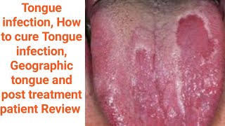 Geographic tongue Tongue infection Mouth inside infection benign migratory glossitis causes amp Tt [upl. by Ekal]