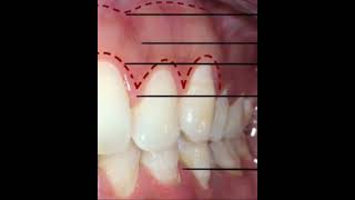 introduction to classification of periodontal diseases [upl. by Namlaz]