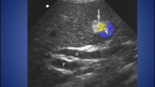 radiology cases echogenic falciform ligament [upl. by Eecyak]