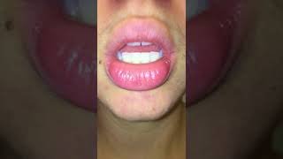 exfoliative cheilitis  day 0 pre treatment  tacrolimus amp burts bees wax hand salve [upl. by Alarise]