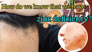 10 most important symptoms of zinc deficiency zinc zinddeficiency [upl. by Tuesday766]