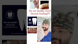 The Ultimate Guide to Dental Teeth Cleaning Everything You Need to Know yt shorts ytshorts [upl. by Stutzman350]