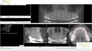 Downloading iCAT Vision Scans [upl. by Atirihs781]