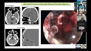 Approach Related Complications for Brain Stem Cavernomas – Professor Maurizio Lacoangeli [upl. by Michel]