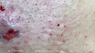 Big Cystic Acne Blackheads Extraction Blackheads amp Milia Whiteheads Removal Pimple Popping [upl. by Kenleigh]