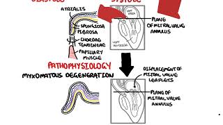 Mitral Valve Prolapse [upl. by Anivek]