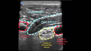 Infraclavicular block with Houdini manoeuvre ultrasound guided [upl. by Izmar]