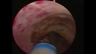 Endoscopic laser urethrotomy Avagyan MC [upl. by Laerol]