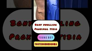 BONE TUMOR bony tumour exostosis proximal tibia shorts trending [upl. by Eward]