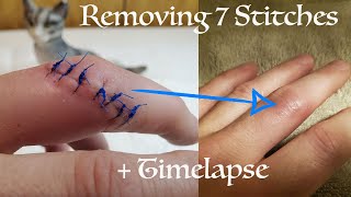 Removing Stitches From Finger amp Timelapse Healing Process [upl. by Horace]