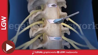 Cervical Discectomy amp Fusion Surgery 3D animation C3 C4 C5 C6 [upl. by Nairde]