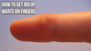 How to Get Rid of Warts on Fingers [upl. by Ademla]