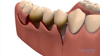 Periodontal flap approach surgery  Lapointe dental centres [upl. by Asher]