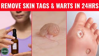 How to Rid Skin Tags and Warts Within 24 Hours  Skin Tag Removal with Garlic amp PovidoneIodine [upl. by Aihsi]