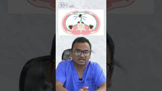 Understanding Ovarian Cancer How it Spreads and Causes Abdominal Swelling  Dr Praveen Kammar SSO [upl. by Zarah566]