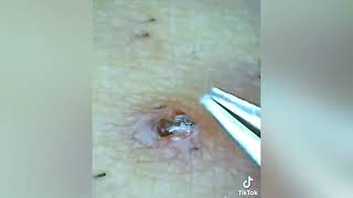 relax and see how to remove ingrown hair [upl. by Eneladgam]