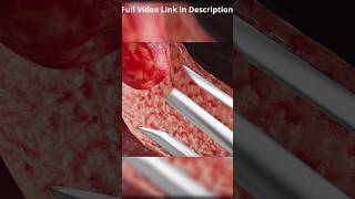 Types of Tubal Ligation🤔  Tubectomy  Laparoscopic  Hysteroscopic [upl. by Gothar842]