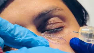 Is Bar Laser Xanthelasma Removal Karwa Liya  Cholesterol Deposit [upl. by Smoot]