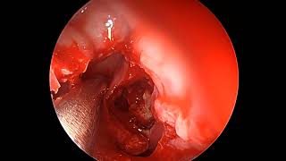 Endoscopic frontal sinusotomy [upl. by Elisabet]