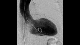 notes on LV angiography  IHD HCM Takotsubo and others [upl. by Birkner]