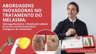 Abordagens Inovadoras no Tratamento do Melasma [upl. by Ynattirb893]