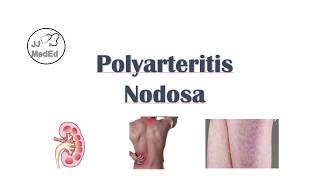 Polyarteritis Nodosa PAN  Signs amp Symptoms Diagnosis Treatment [upl. by Callida]