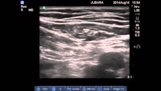 genitofemoral nerve block [upl. by Nilreb]