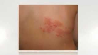 How to treat shingles over the counter and how to cure shingles in 3 days [upl. by Reuven]