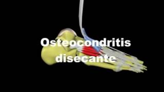 Osteocondritis Disecante [upl. by Susejedesoj]