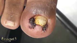 🎞️CLÁSSICO UM PROCEDIMENTO INACREDITÁVEL  ESPÍCULAS BAIANAS nails ingrowntoenail [upl. by Siri]