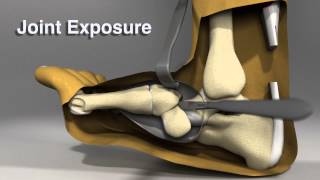 Midfoot Charcot Reconstruction Strategy [upl. by Alehtse926]