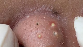 Big Cystic Acne Blackheads Extraction Blackheads amp Milia Whiteheads Removal Pimple Popping  3709 [upl. by Kolodgie]