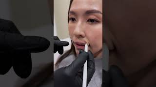 A little filler a lot of wow 👄✨｜DR D AESTHETICS CLINIC SINGAPORE [upl. by Bayly]