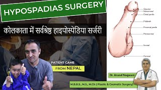 Best HYPOSPADIAS Surgery in Kolkata  Patient Came from Nepal  Best Age for Hypospadias Surgery [upl. by Ran]