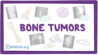 Bone tumors  causes symptoms diagnosis treatment pathology [upl. by Markiv]