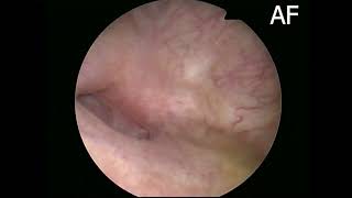 vesicovaginal fistula cystoscopy appearance [upl. by Lauro909]