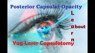 What is Posterior Capsular Opacity amp Yag Laser Capsulotomy Hindi [upl. by Akimehs]