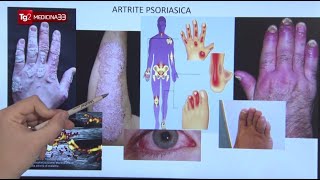 Artrite psoriasica sintomi diagnosi e trattamenti con nuovi farmaci biotecnologici [upl. by Anh394]