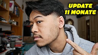 MEIN MINOXIDIL BART EXPERIMENT UPDATE 11 MONATE NEWS [upl. by Hervey]