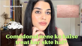 How to get rid of comedones How to treat comedonal acne how I treated my acne acne skincare [upl. by Notsej]