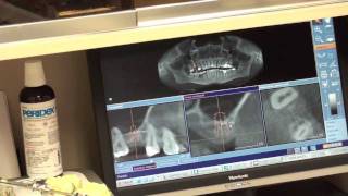 EXPLICIT  Internal Sinus lift  Osteotome technique  Dental Surgery [upl. by Aizirtap420]