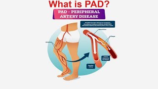 Mastering Vascular Health All you Need to Know About Peripheral Arterial Disease PAD Gujarati [upl. by Olimpia459]