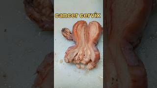 Cancer cervix புற்று நோய் கருப்பை வாய்  gallstones tissuefixation cervicalcancersymptoms [upl. by Estis924]